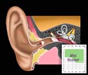 Illustratie van Mini Receiver in het oor met bijbehorend audiogram.